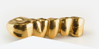 Zahngold-Legierungen - Der unsichtbare Wert