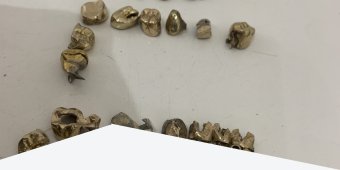 Das ABC des Verkaufs von Zahngold