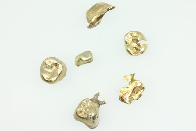 Zahngold in Nettetal verkaufen